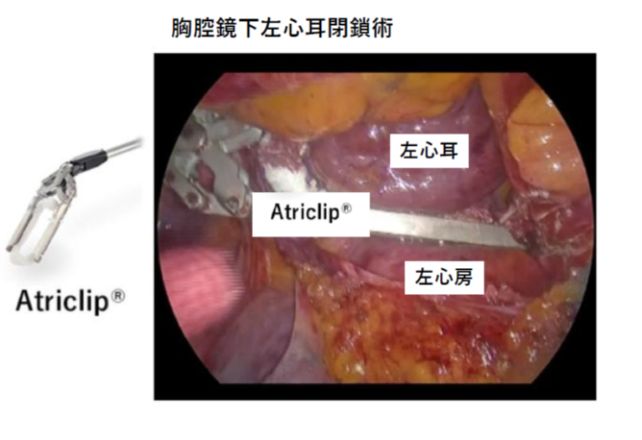 胸腔鏡下左心耳閉鎖術写真