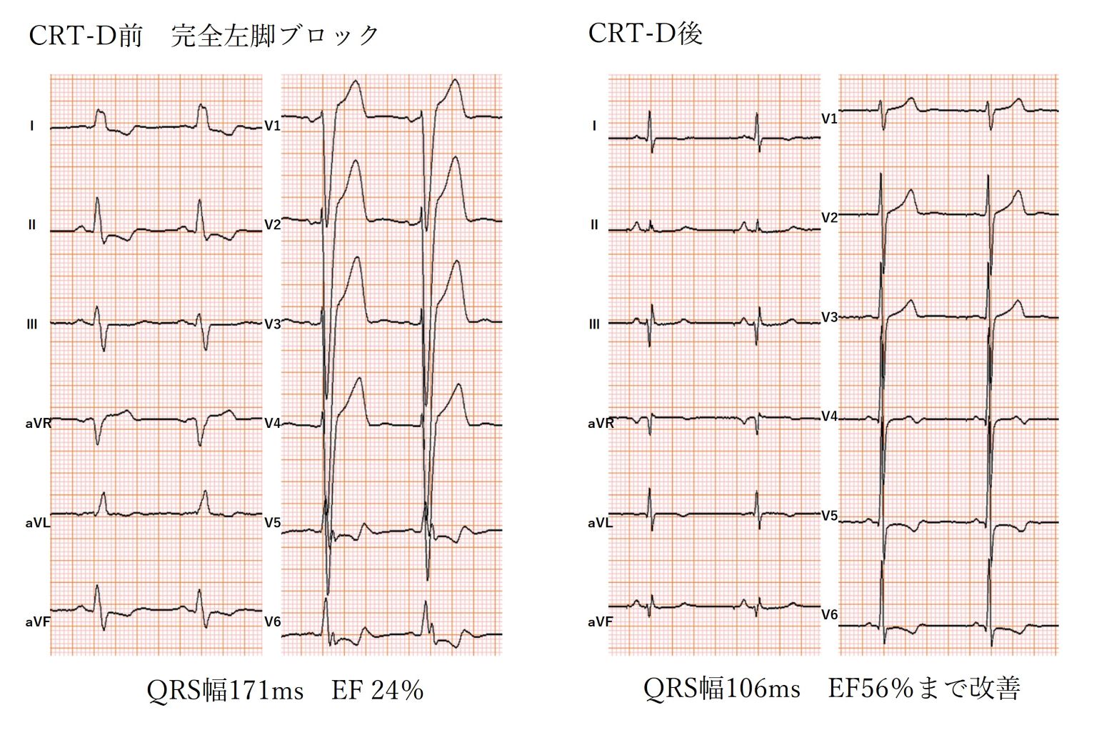 CRT-D前 完全左脚ブロック QRS幅171ms EF24%・CRT-D後 QRS幅106ms EF56%まで改善